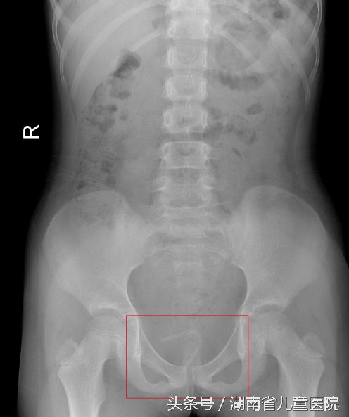 女童妇科病是什么原因,女医生不谨慎发现女童有妇科病