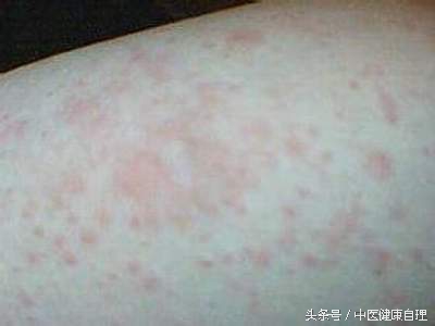 湿疹中医辨证,湿疹性皮炎中医辨证