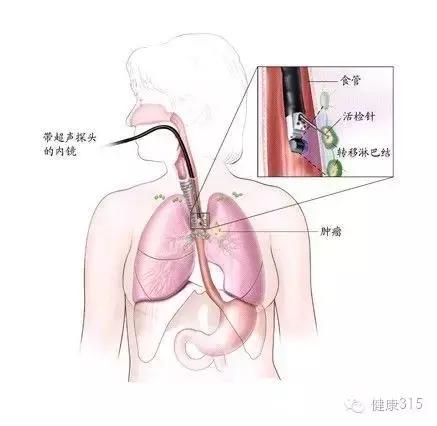 食管癌的根治性放疗适应症,食管癌诊疗规范放疗更新要点
