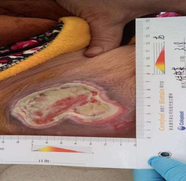 老人长期卧床皮肤有破皮,长期卧床导致皮肤破溃用什么药