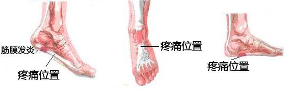 足底筋膜炎还可以跑步吗,跑步足底筋膜炎康复训练