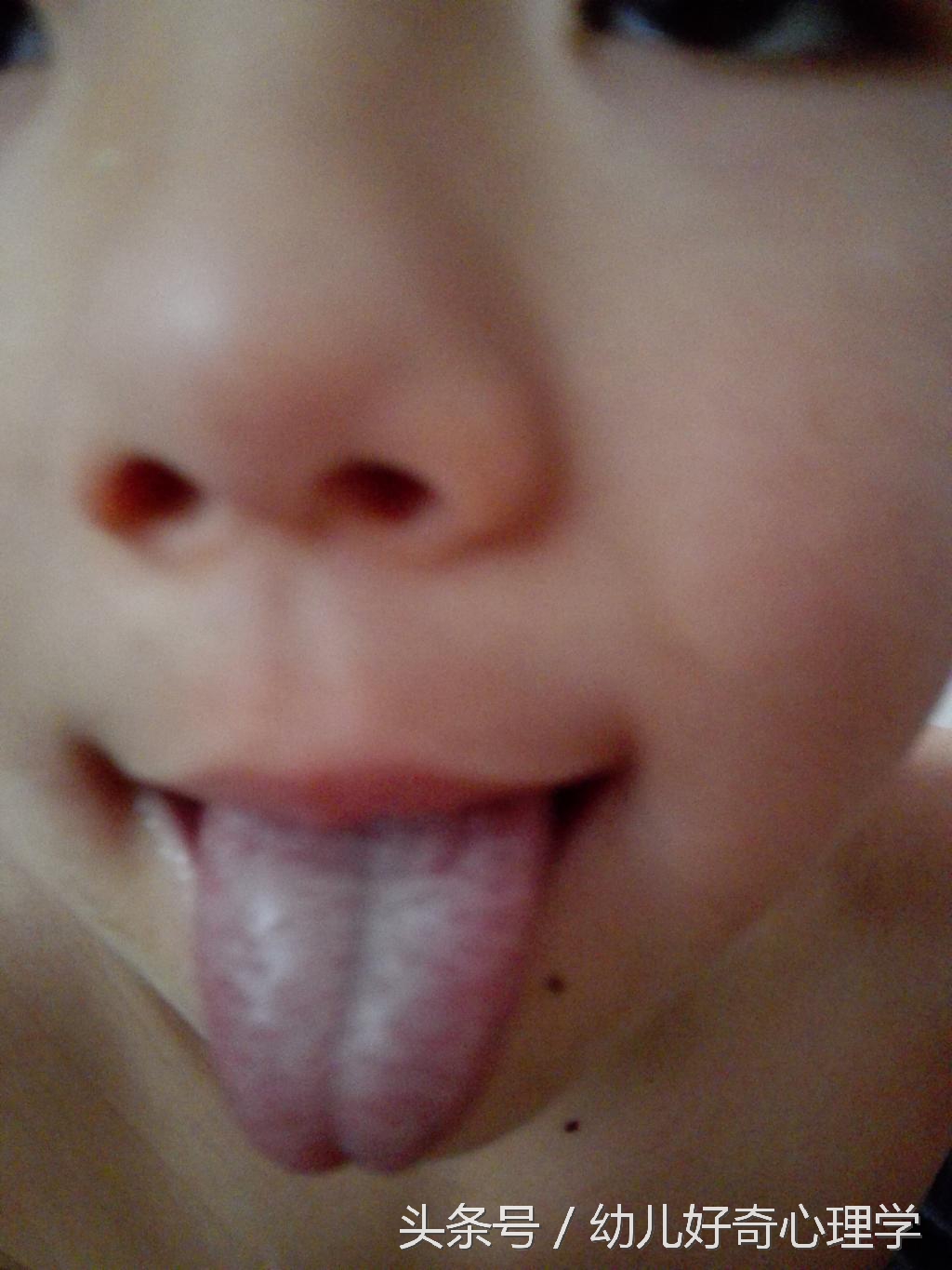 婴幼儿舌头发黑是怎么回事,婴幼儿舌头发紫的图片