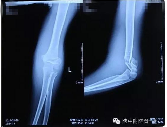 肱骨髁上骨折闭合复位手术记录,小儿肱骨髁上骨折手术恢复的概率