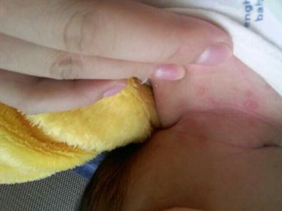 宝宝湿疹怎么治能除根,蓓氏婴儿奶癣湿疹膏有激素吗