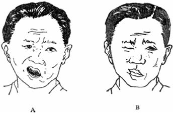 面神经炎的中医诊疗与中医护理