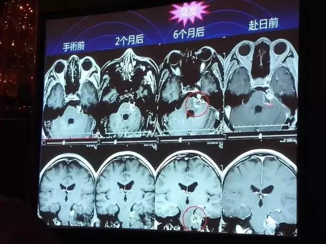 癌症复发转移还可以做质子治疗吗,质子治疗后复发可以用质子治疗吗