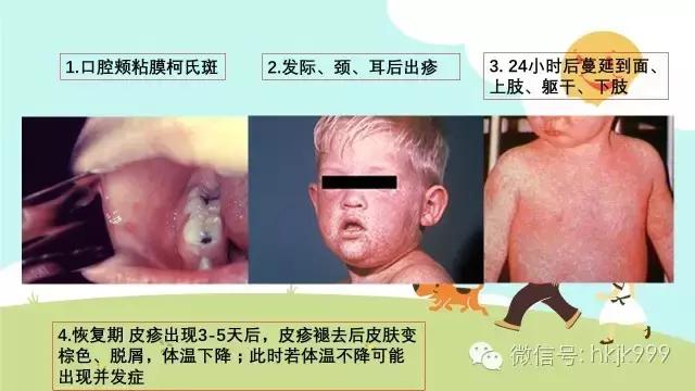 儿童麻疹症状及处理方法,小儿麻疹的症状和关注事项