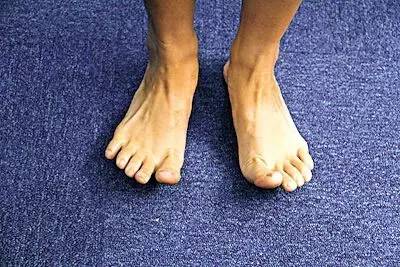 足底筋膜炎还可以跑步吗,跑步足底筋膜炎康复训练