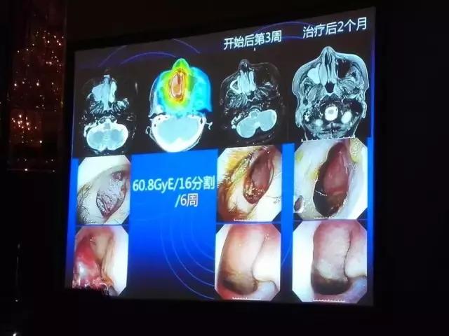 癌症复发转移还可以做质子治疗吗,质子治疗后复发可以用质子治疗吗