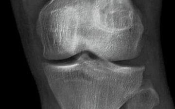 类风湿关节炎误区,类风湿的8大误区