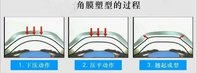 孩子近视100度如果不戴眼镜会怎样,近视500度长期不戴眼镜的后果