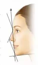 牙齿矫正跟颧骨有什么关系,牙齿矫正和凸嘴的区别