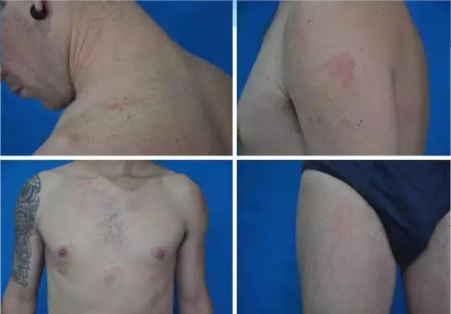 巴西男子身上莫名出现多处“鞭”痕，只因做了这件事...