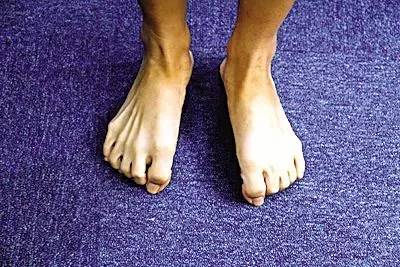 足底筋膜炎还可以跑步吗,跑步足底筋膜炎康复训练