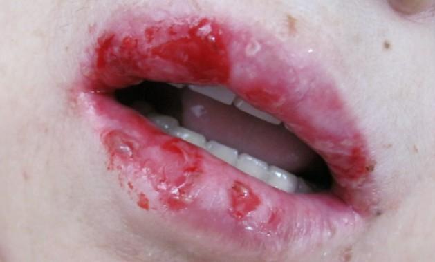 嘴上长泡长疱疹瘙痒怎么办关注这几点。。。