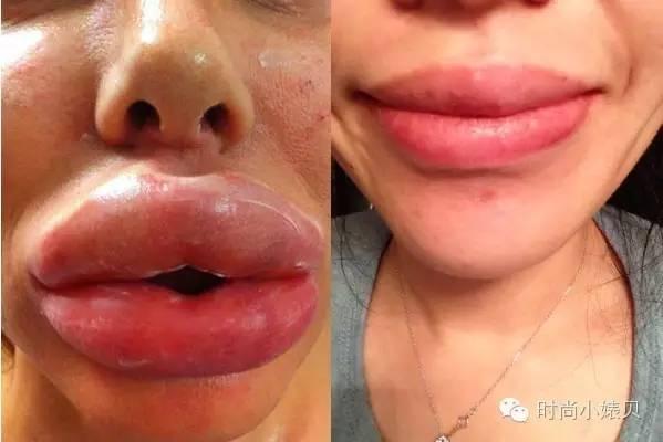 玻尿酸丰唇心得,丰唇失败了如何化妆拯救