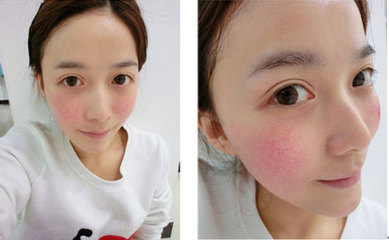 脸上有血丝怎么修复,脸上有红血丝怎样调理