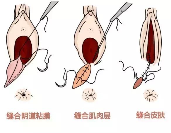 会阴侧切非做不可吗？几招预防方法教给您
