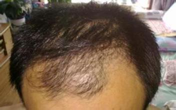 头发上出油用中药怎么治,头发爱出油脱发吃什么中成药调理