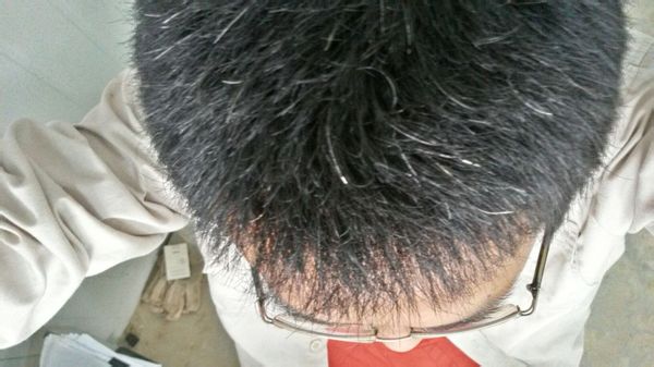 少白头变黑教程,14岁少白头吃什么能变黑