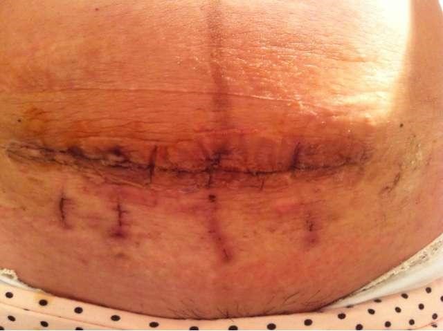 剖腹产后伤口里面有个疤鼓起来,剖腹产的疤时间越久颜色越淡吗