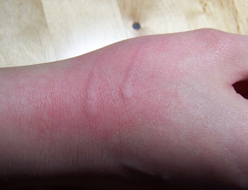 不谨慎被自家的狗狗咬了一口,不谨慎被狗狗咬手