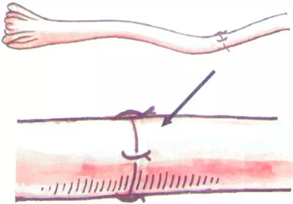 女性二胎后做结扎有影响吗,二胎结扎后想生三胎