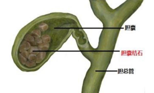 胆结石切完胆之后容易得胰腺炎吗,胆结石切了胆囊