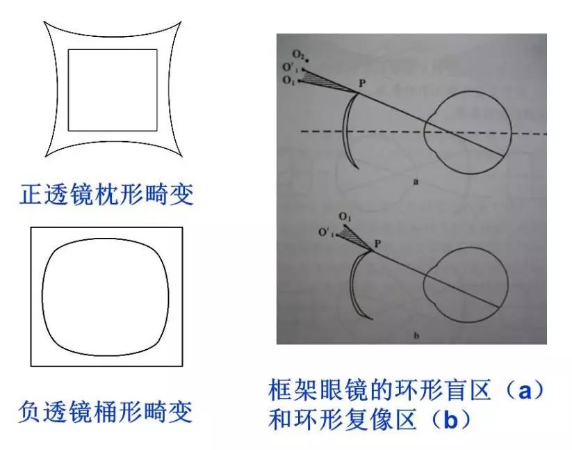 CCOS2016刘陇黔：弱视屈光矫正