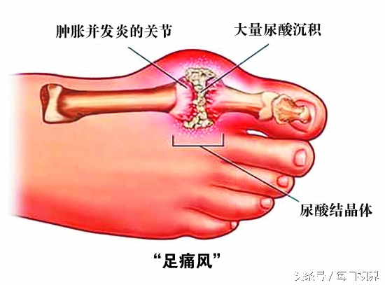 如何控制尿酸,如何才能控制尿酸水平