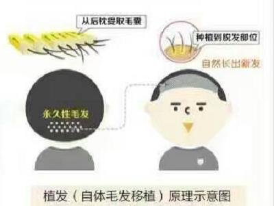 孔蒂植发效果图,孔蒂脱发