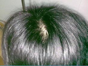 掉头发严重如何生发,掉头发很厉害怎样可以生发