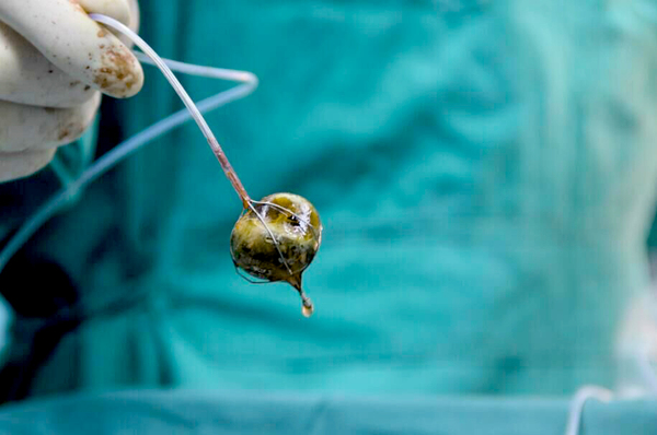 胆结石切完胆之后容易得胰腺炎吗,胆结石切了胆囊