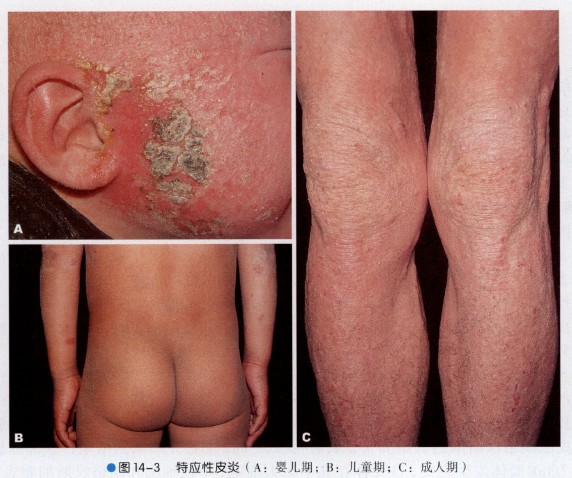 孩子反复湿疹皮炎怎么回事,婴儿长期湿疹会变成特应性皮炎吗