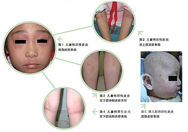 孩子反复湿疹皮炎怎么回事,婴儿长期湿疹会变成特应性皮炎吗