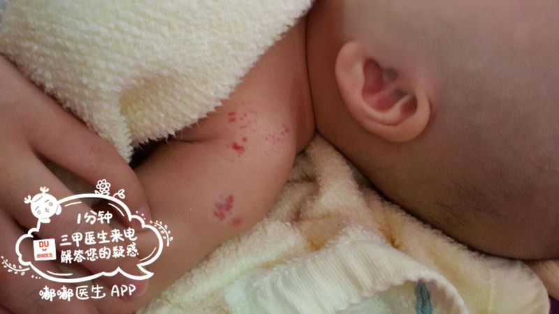 小孩输液为什么会有血,婴儿输液出血了怎么办