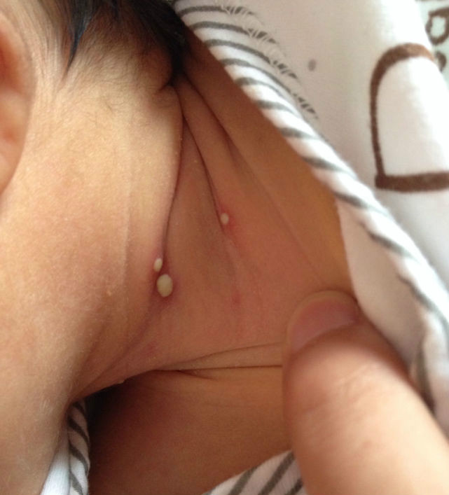 宝宝长脓包是因为什么,宝宝身上长了脓包型痘痘怎么办