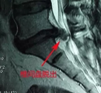 椎间孔镜治疗腰椎间盘突出靠谱吗,腰间盘突出椎间孔镜手术后复发