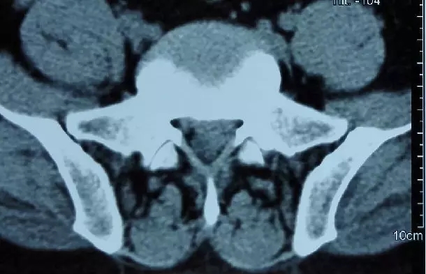 椎间孔镜治疗腰椎间盘突出靠谱吗,腰间盘突出椎间孔镜手术后复发