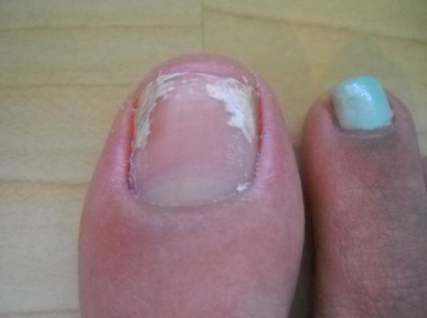 指甲上发现白点,指甲上有白点为什么要看皮肤科