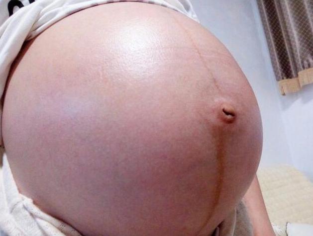 羊水早破了34周需要打促肺针吗,羊水早破只剩4cm