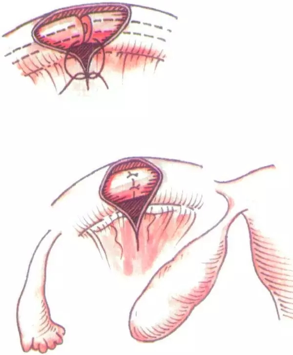 女性二胎后做结扎有影响吗,二胎结扎后想生三胎