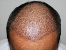 脂溢性脱发的生发养发药膳