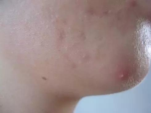 脸上突然冒出一堆大痘痘什么原因,脖子后面脸上都长了很多红色痘痘