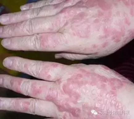 中医说吃醪糟的好处,中医说伤阴最严重症状