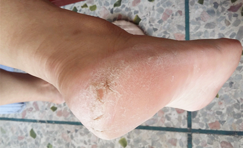 脚部干裂怎么治疗最好,脚部干裂疼痛有什么办法