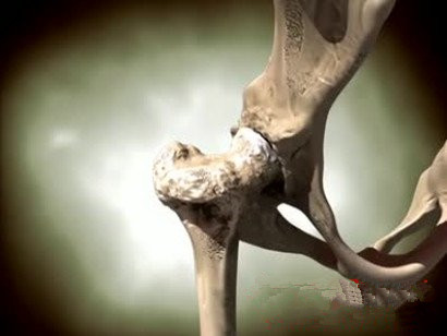 股骨头坏死有哪些保髋治疗方法,股骨头坏死保髋治疗后要不要拐杖