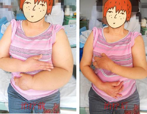 90后艺人徐婷去世原因,艺人徐婷淋巴癌症状