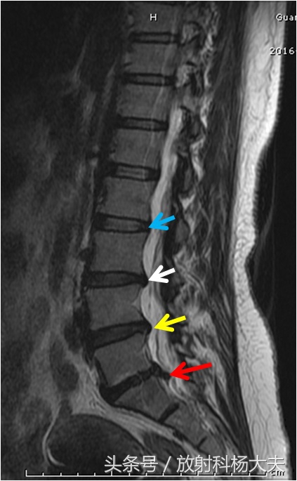除了腰间盘突出还有什么导致腰疼,除了腰间盘突出别的都不突出