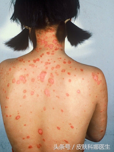感冒发烧后身上起红疹,感冒发烧完身上长了一身牛皮癣